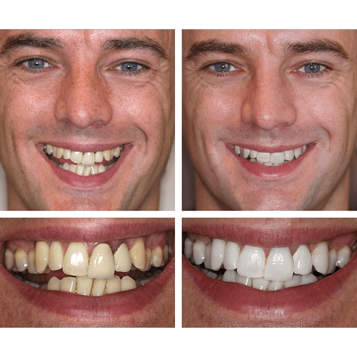 LANTHOME™ | Teeth Whitening Essence - Free  Protected Shipping!