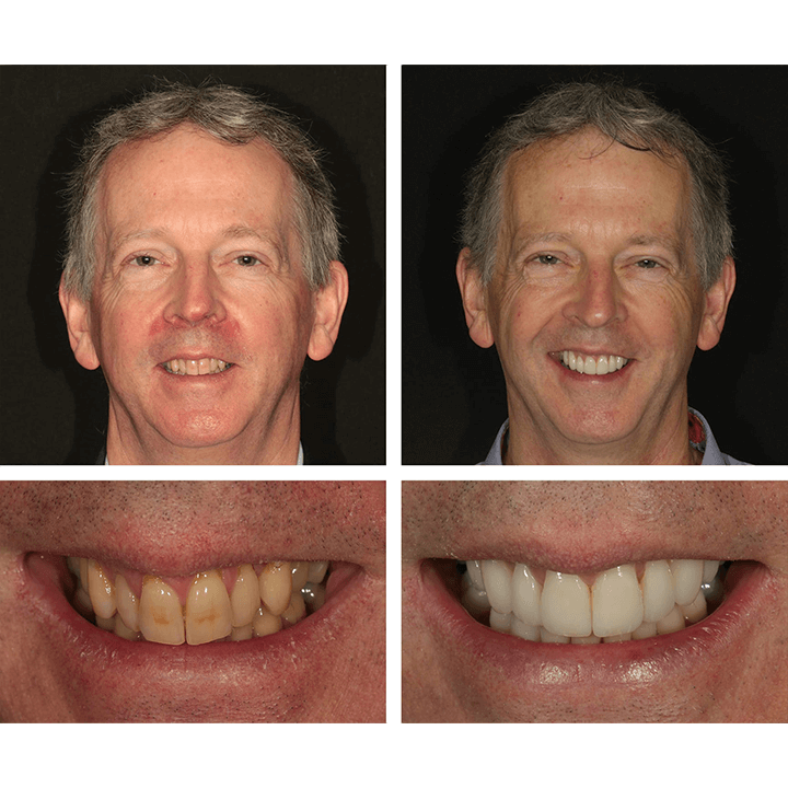 LANTHOME™ | Teeth Whitening Essence - Free  Protected Shipping!