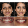 LANTHOME™ | Teeth Whitening Essence - Free  Protected Shipping!