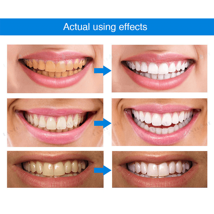LANTHOME™ | Teeth Whitening Essence - Free  Protected Shipping!